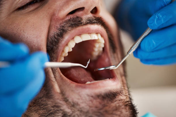 Best Broken or Chipped Tooth Repair in Olga, FL